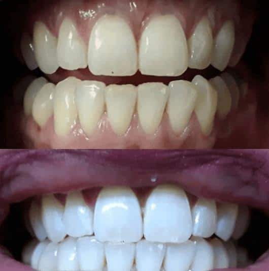 Teeth Whitening